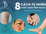 8 Cách Tự Nhiên Chữa Giãn Tĩnh Mạch