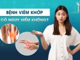 Bệnh viêm khớp có nguy hiểm không?