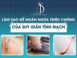 Làm Sao Để Ngăn Ngừa Triệu Chứng Của Suy Giãn Tĩnh Mạch