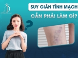 SUY GIÃN TĨNH MẠCH - CẦN PHẢI LÀM GÌ?