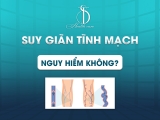 Suy Giãn Tĩnh Mạch Nguy Hiểm Không?