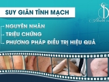 Suy Giãn Tĩnh Mạch: Nguyên Nhân, Triệu Chứng Và Phương Pháp Điều Trị Hiệu Quả
