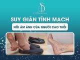SUY GIÃN TĨNH MẠCH NỖI ÁM ẢNH CỦA NGƯỜI CAO TUỔI