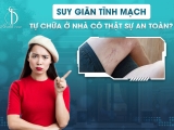 Suy Giãn Tĩnh Mạch - Tự Chữa Ở Nhà Có Thật Sự An Toàn?