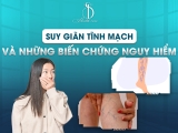 Suy Giãn Tĩnh Mạch Và Những Biến Chứng Nguy Hiểm