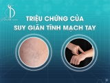 Triệu Chứng Của Suy Giãn Tĩnh Mạch Tay