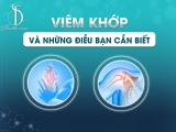 Viêm Khớp Và Những Điều Bạn Cần Biết!