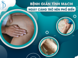 Giãn Tĩnh Mạch Có Nguy Hiểm Hay Không?