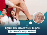 Bệnh Suy Giãn Tĩnh Mạch Liệu Có Chữa Được Không?