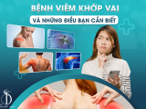 Bệnh Viêm Khớp Vai Và Những Điều Bạn Cần Biết 