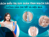Cách Điều Trị Suy Giãn Tĩnh Mạch Sâu: Hướng Dẫn Chi Tiết và Hiệu Quả