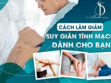 CÁCH LÀM GIẢM SUY GIÃN TĨNH MẠCH DÀNH CHO BẠN
