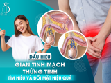 Dấu Hiệu Giãn Tĩnh Mạch Thừng Tinh: Tìm Hiểu Và Đối Mặt Hiệu Quả