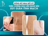 Đừng Bỏ Qua Bất Kỳ Triệu Chứng Nào Liên Quan Đến Suy Giãn Tĩnh Mạch