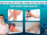 ĐỪNG NÊN BỎ QUA BẤT KỲ TRIỆU CHỨNG NÀO LIÊN QUAN ĐẾN SUY GIÃN TĨNH MẠCH