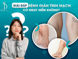Giải Đáp: Bệnh Giãn Tĩnh Mạch Có Nguy Hiểm Không?