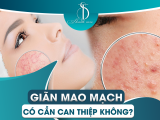GIÃN MAO MẠCH CÓ CẦN CAN THIỆP KHÔNG?