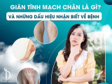 Giãn Tĩnh Mạch Chân Là Gì? Và Những Dấu Hiệu Nhận Biết Về Bệnh