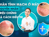 Giãn Tĩnh Mạch Ở Mặt: Nguyên Nhân, Triệu Chứng Và Cách Điều Trị