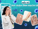 Hiểu Rõ Suy Giãn Tĩnh Mạch Sâu