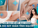LÀM SAO ĐỂ BIẾT ĐAU CHÂN LÀ DO SUY GIÃN TĨNH MẠCH?