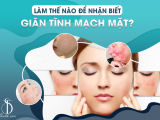 Làm Thế Nào Để Nhận Biết Giãn Tĩnh Mạch Mặt?