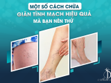 Một Số Cách Chữa Giãn Tĩnh Mạch Hiệu Quả Mà Bạn Nên Thử