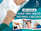 NẾU CHÂN BỊ GIÃN TĨNH MẠCH THÌ PHẢI LÀM SAO?