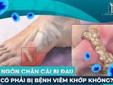 Ngón Chân Cái Bị Đau Có Phải Bị Bệnh Viêm Khớp Không?