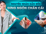 Nguyên Nhân Dẫn Đến Sưng Ngón Chân Cái
