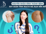 Nguyên Nhân Hình Thành Bệnh Suy Giãn Tĩnh Mạch Mà Bạn Nên Biết 
