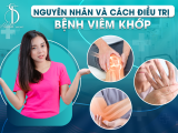 Nguyên Nhân Và Cách Điều Trị Bệnh Viêm Khớp