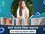 SUY GIÃN TĨNH MẠCH CÓ THẬT SỰ NGUY HIỂM?