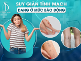 SUY GIÃN TĨNH MẠCH ĐANG Ở MỨC BÁO ĐỘNG