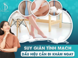 SUY GIÃN TĨNH MẠCH - DẤU HIỆU CẦN ĐI KHÁM NGAY