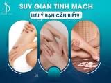 SUY GIÃN TĨNH MẠCH - LƯU Ý BẠN CẦN BIẾT!!!