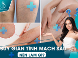 Suy Giãn Tĩnh Mạch Nên Làm Gì? Bạn đã biết chưa?