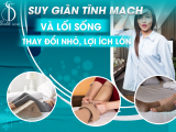 SUY GIÃN TĨNH MẠCH VÀ LỐI SỐNG - THAY ĐỔI NHỎ, LỢI ÍCH LỚN