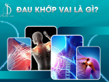 Đau Khớp Vai Là Gì?