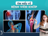 Tìm hiểu về bệnh viêm khớp
