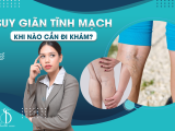 Suy giãn tĩnh mạch Khi nào cần đi khám?
