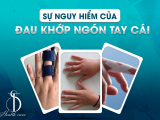 Sự Nguy Hiểm Của Đau Khớp Ngón Tay Cái