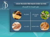Cách Trị Giãn Tĩnh Mạch Chân Tại Nhà: Bí Quyết Từ Chuyên Gia