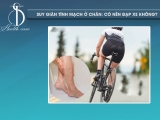 Suy Giãn Tĩnh Mạch Ở Chân: Có Nên Đạp Xe Không?