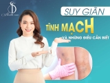 GIÃN TĨNH MẠCH VÀ NHỮNG ĐIỀU CẦN BIẾT!