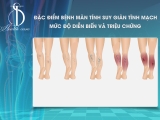 Đặc điểm bệnh mãn tính suy mãn tĩnh mạch, mức độ diễn tiến và các triệu chứng biểu hiện của bệnh?