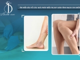Tìm Hiểu Sâu Về Các Giải Pháp Điều Trị Suy Giãn Tĩnh Mạch Chi Dưới