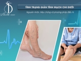 Tình Trạng Giãn Tĩnh Mạch Chi Dưới: Nguyên Nhân, Triệu Chứng và Phương Pháp Điều Trị
