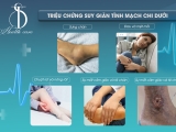 Triệu Chứng Suy Giãn Tĩnh Mạch Chi Dưới