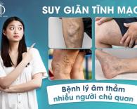 Suy giãn tĩnh mạch - Bệnh lý âm thầm nhiều người chủ quan